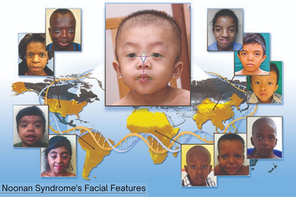 Celebrities With Noonan Syndrome: Inspiring Lives